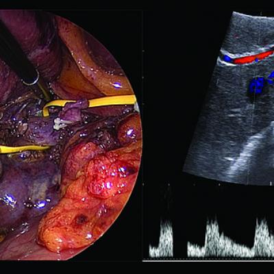 Giá trị của siêu âm trong mổ xác định vị trí khối U