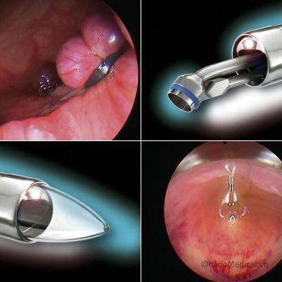 Dụng cụ soi hậu môn trực tràng thắt trĩ